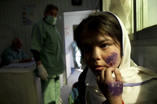 Şark Çıbanı hastalığına yakalanmış 14 yaşındaki bir kız çocuğu Dünya Sağlık Örgütüne (WHO) ait klinikte tedavi edilmeyi beklerken; Kabil, Afganistan, 26 Ekim 2010. (Paula Bronstein / Getty Images)